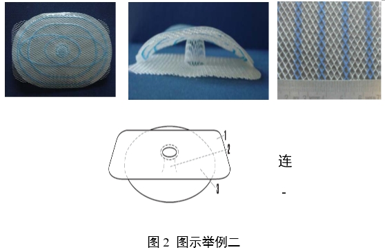 疝修補(bǔ)補(bǔ)片注冊(cè)審查指導(dǎo)原則(2023年修訂版)(2023年第9號(hào))(圖5) 疝修補(bǔ)補(bǔ)片注冊(cè)審查指導(dǎo)原則(2023年修訂版)(2023年第9號(hào))(圖5)